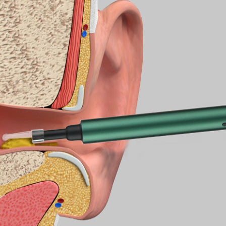 Removedor de cera de ouvido do otoscópio MPG