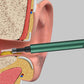 Removedor de cera de ouvido do otoscópio MPG